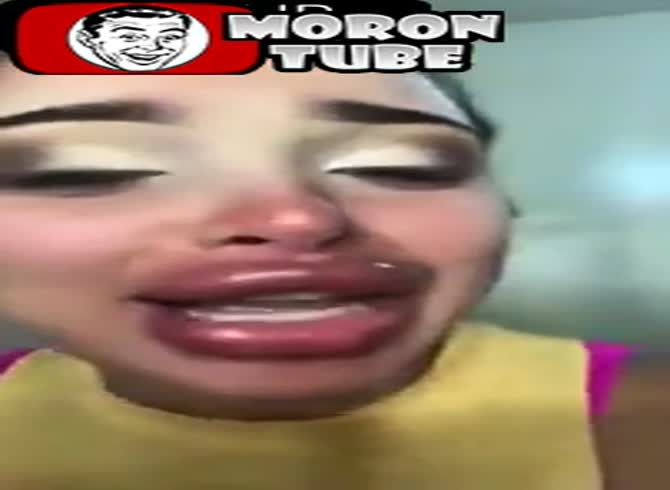 Video :Extremely full lips following a terrible cosmetic surgery procedure